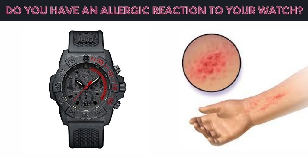 Do you have an allergic reaction to your watch?